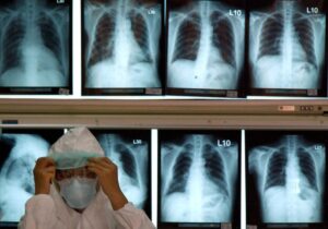 Read more about the article Universidade de Kyoto faz transplante pioneiro de pulmões a doente de covid-19